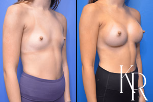 Breast augmentation before and after photo, front view