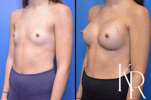 Breast augmentation before and after photo, front view