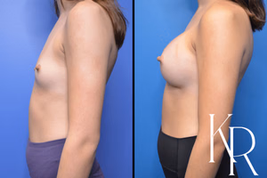 Breast augmentation before and after photo, side view