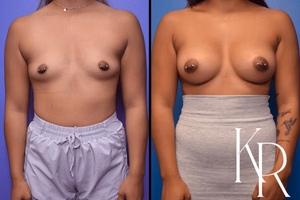 Breast augmentation before and after photo, front view