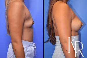 Breast augmentation before and after photo, side view
