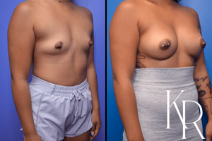 Breast augmentation before and after photo, front view