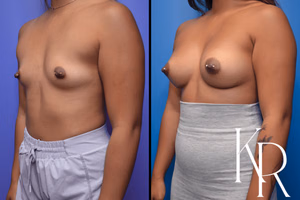 Breast augmentation before and after photo, front view