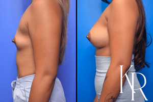 Breast augmentation before and after photo, side view