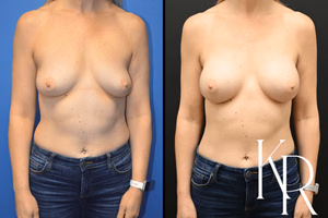 Breast augmentation before and after photo, front view