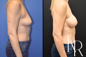 Breast augmentation before and after photo, side view