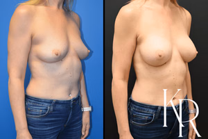 Breast augmentation before and after photo, front view