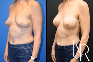Breast augmentation before and after photo, front view