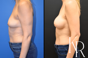Breast augmentation before and after photo, side view