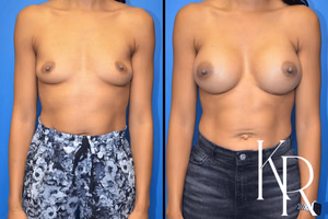 Breast augmentation before and after photo, side view