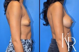 Breast augmentation before and after photo, front view