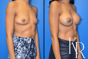 Breast augmentation before and after photo, side view