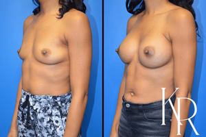 Breast augmentation before and after photo, front view