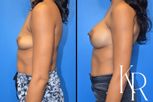 Breast augmentation before and after photo, side view