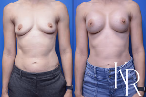 Breast augmentation before and after photo, front view