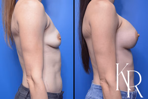 Breast augmentation before and after photo, side view