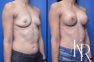 Breast augmentation before and after photo, front view