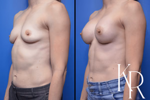 Breast augmentation before and after photo, front view