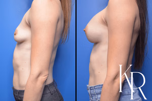 Breast augmentation before and after photo, side view