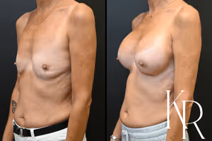 Breast augmentation before and after photo, front view