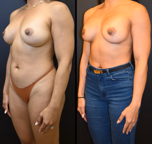 Breast augmentation revision before and after photo, front view