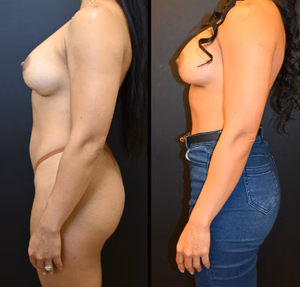 Breast augmentation revision before and after photo, side view