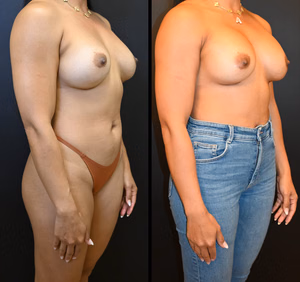 Breast augmentation revision before and after photo, front view