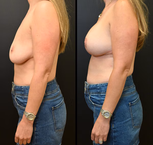 Breast augmentation revision before and after photo, side view