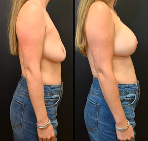 Breast augmentation revision before and after photo, side view