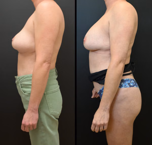 Breast augmentation revision before and after photo, side view