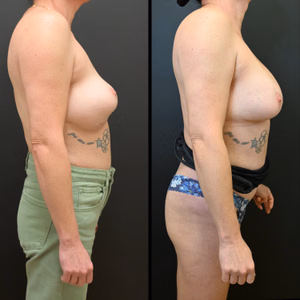 Breast augmentation revision before and after photo, side view