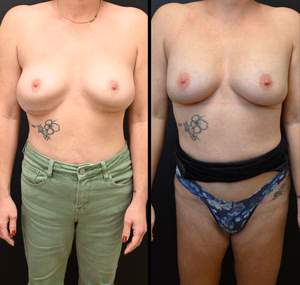 Breast augmentation revision before and after photo, front view