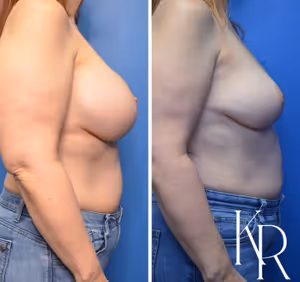 Breast implant removal before and after photo, side view