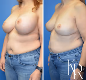 Breast implant removal before and after photo, front view