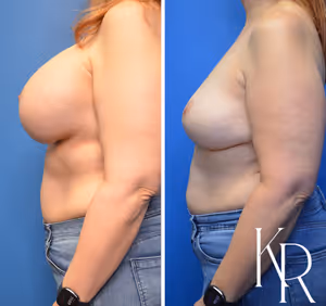 Breast implant removal before and after photo, side view