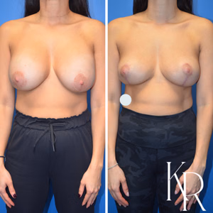 Breast implant removal before and after photo, front view