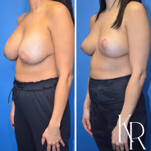 Breast implant removal before and after photo, side view
