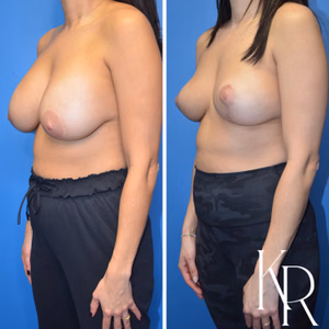 Breast implant removal before and after photo, side view