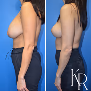 Breast implant removal before and after photo, front view