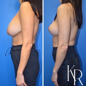 Breast implant removal before and after photo, front view