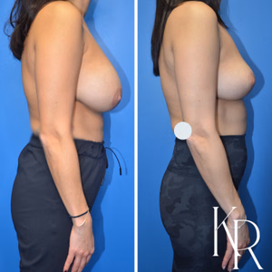 Breast implant removal before and after photo, front view