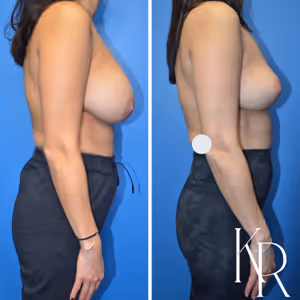 Breast implant removal before and after photo, front view