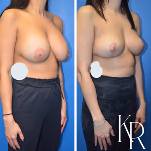 Breast implant removal before and after photo, side view