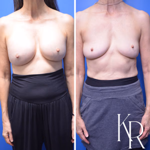 Breast implant removal before and after photo, front view