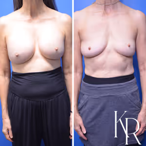 Breast implant removal before and after photo, front view