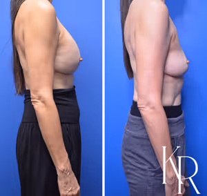 Breast implant removal before and after photo, side view