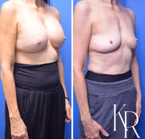 Breast implant removal before and after photo, front view