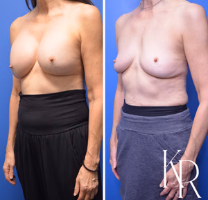 Breast implant removal before and after photo, front view