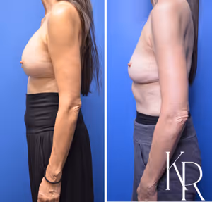 Breast implant removal before and after photo, side view