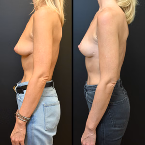 Breast lift before and after photo, side view
